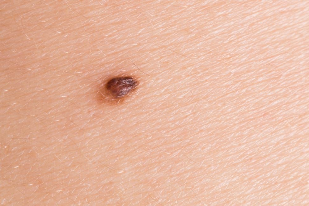 petite chirurgie dermatologique