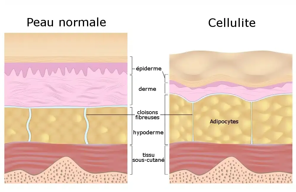 schema formation de la cellulite
