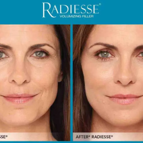 Radiesse injection anti age.png